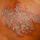Illustration for article titled Obat Penyakit Herpes Ampuh Manjurem/em